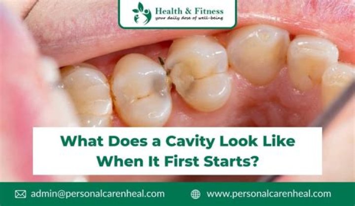 How does a cavity look like when it starts?