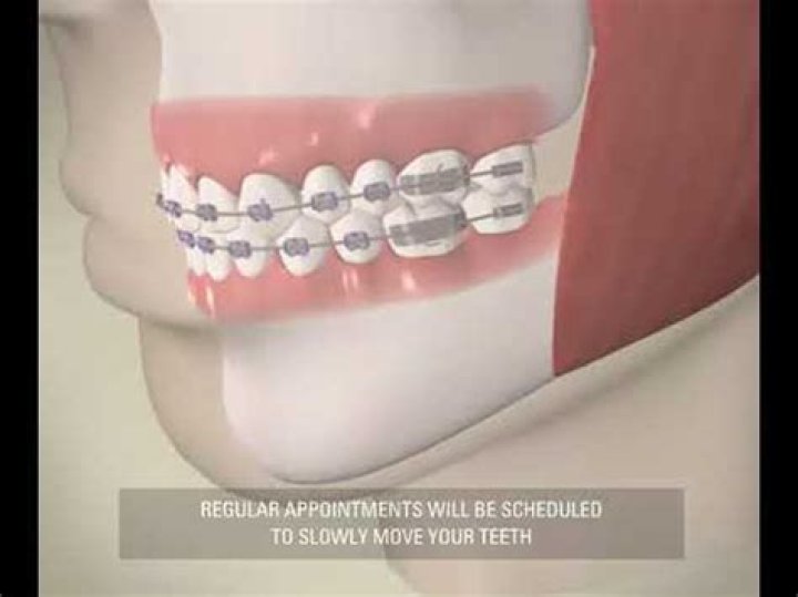 How fast do teeth move with braces?