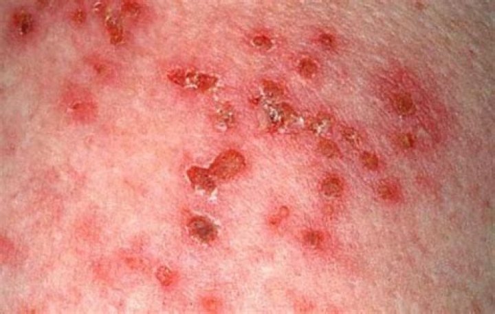 How is shingles spread airborne?