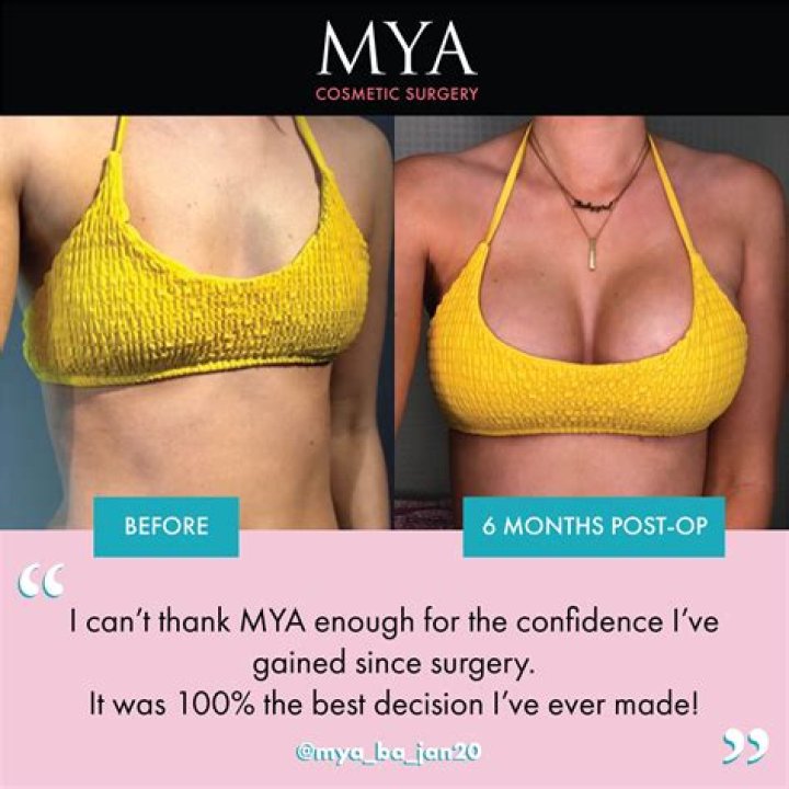 How long after breast augmentation can I vacuum?