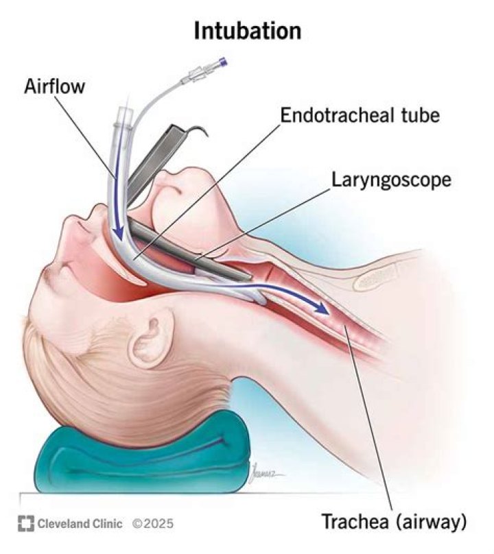 How long after intubation can you talk?