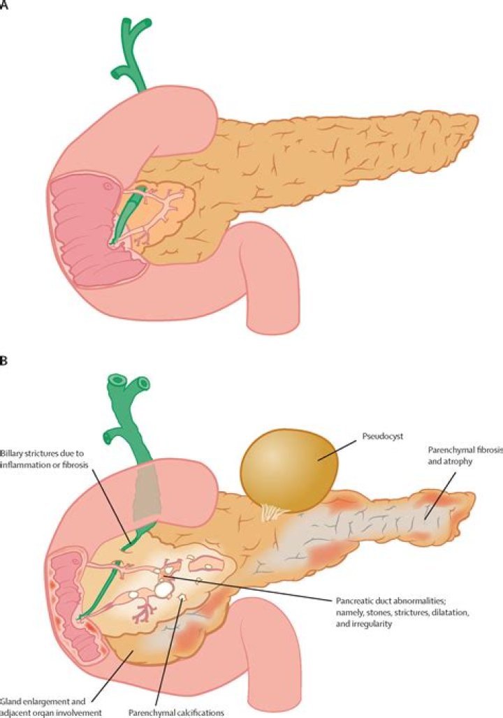 How long can pancreatitis go untreated?
