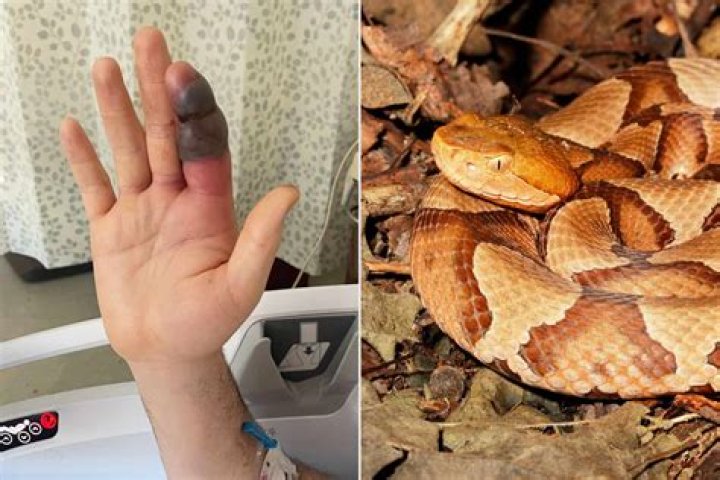 How long can you live after a copperhead bite?