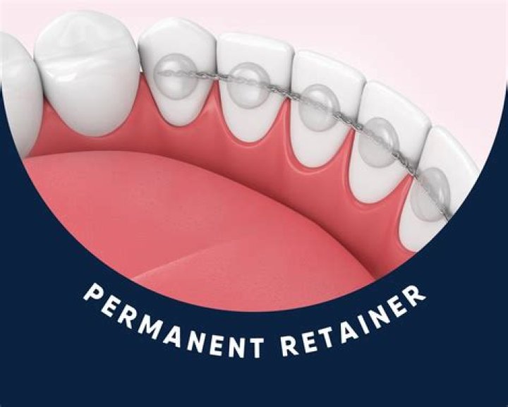 How long do you wear a metal retainer?