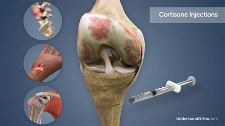 How long does cortisone shot last for plantar fasciitis?