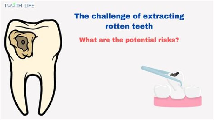 How long does it take for a rotten tooth to fall out?