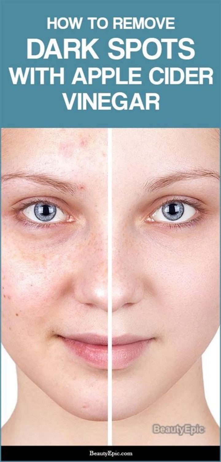How long does it take for apple cider vinegar to remove dark spots?