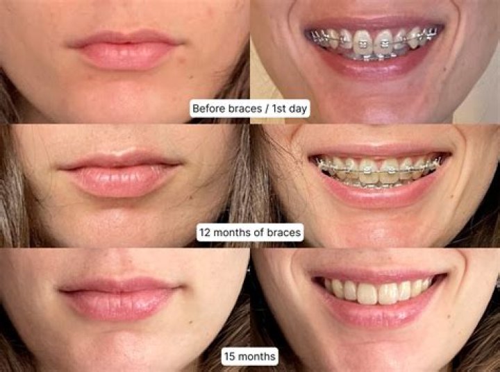 How long will braces hurt after tightening?