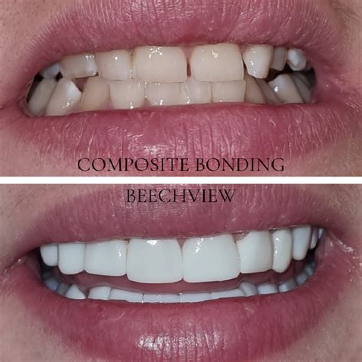 How many teeth do you get composite bonding on?
