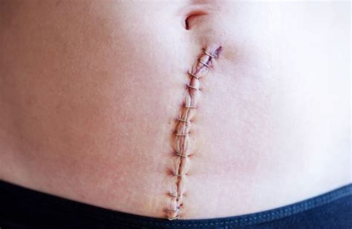 How many types of stitches are used in cesarean delivery?
