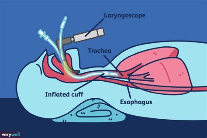 How painful is being intubated?