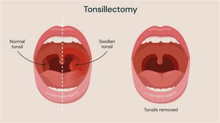 How painful is tonsillectomy recovery in adults?