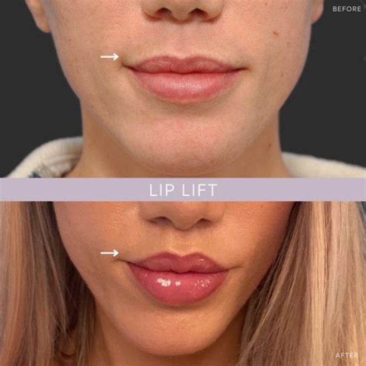 Is a lip lift painful?