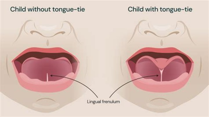 Is a tongue-tie normal?