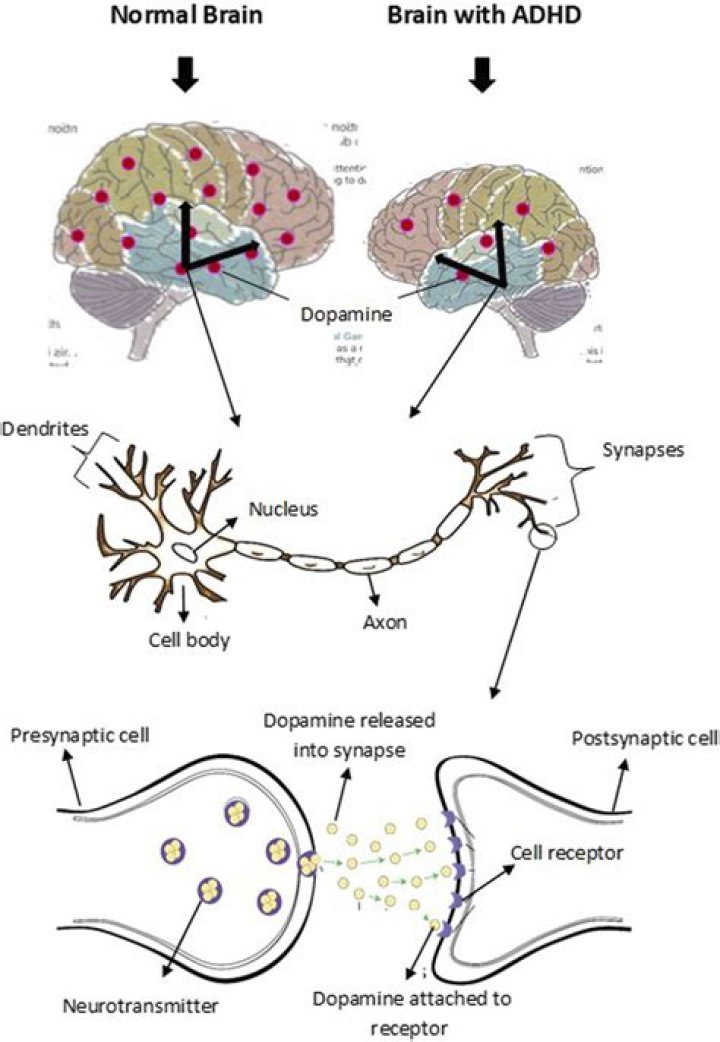 Is ADHD low dopamine?