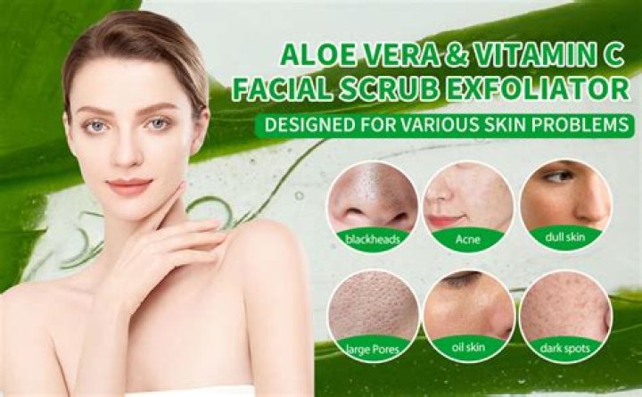 Is aloe vera good for blackheads?