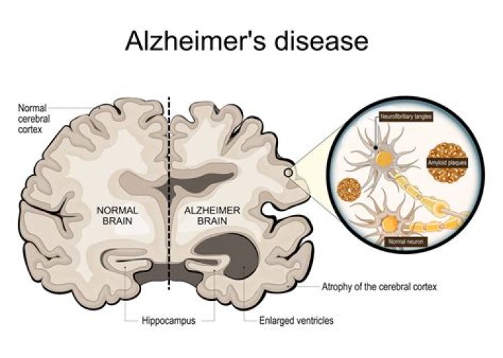 Is Alzheimer's passed on by mother or father?