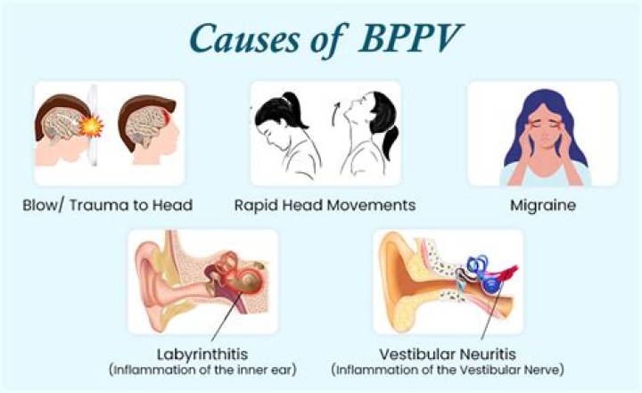 Is BPPV caused by stress?