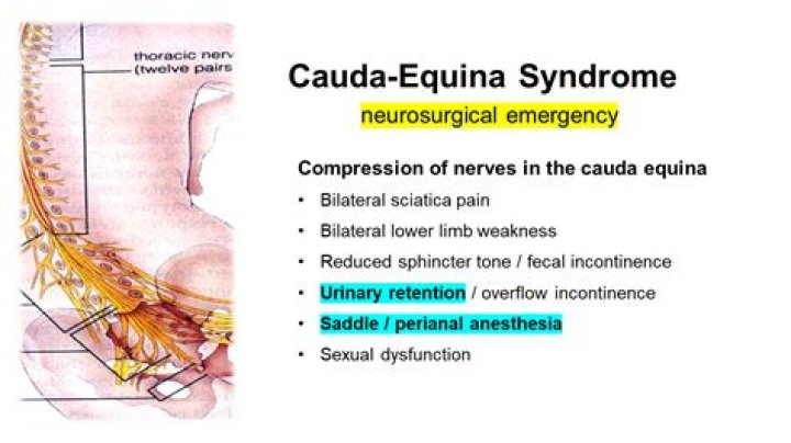Is cauda equina an emergency?