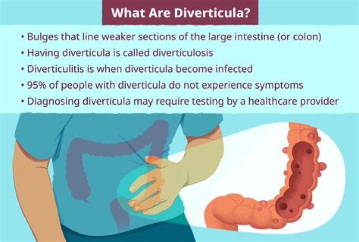 Is diverticulitis a bowel disease?