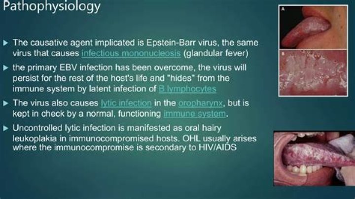 Is Epstein-Barr virus the same as glandular fever?