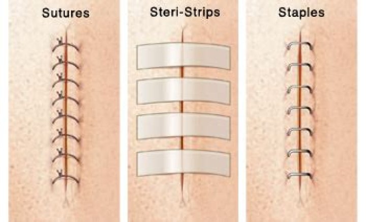 Is glue or staples better for C-section?