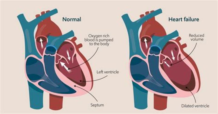 Is heart failure painful death?