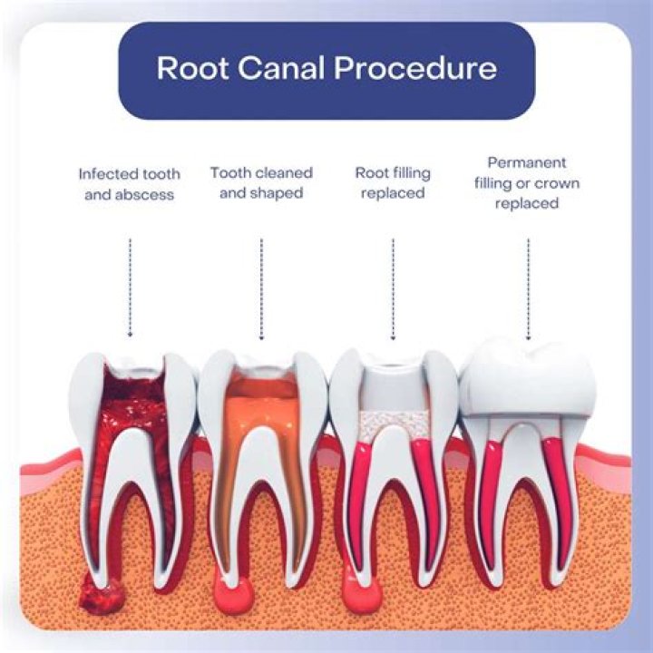 Is it better to have a root canal or tooth pulled?