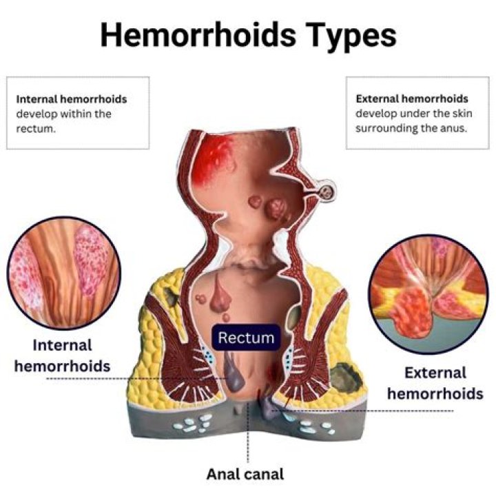 Is it OK to ice a hemorrhoid?