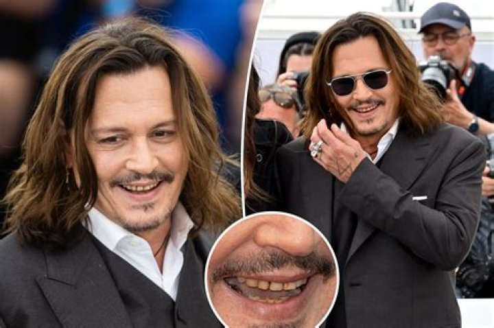 Is Johnny Depp's teeth rotten?