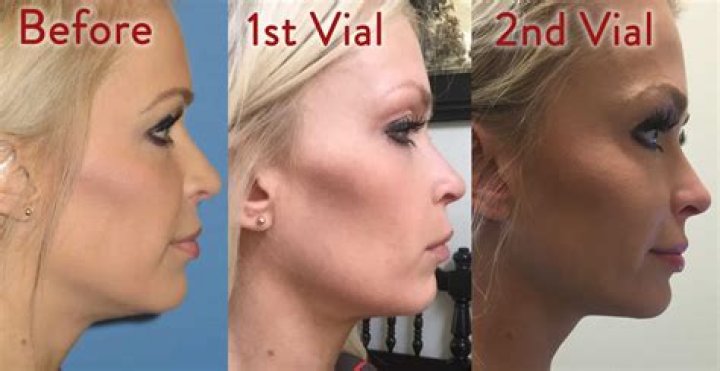 Is Kybella worth the money?