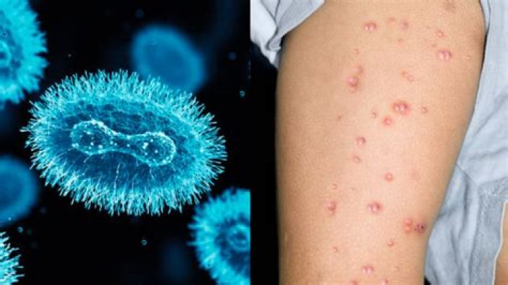 Is monkey pox a virus?