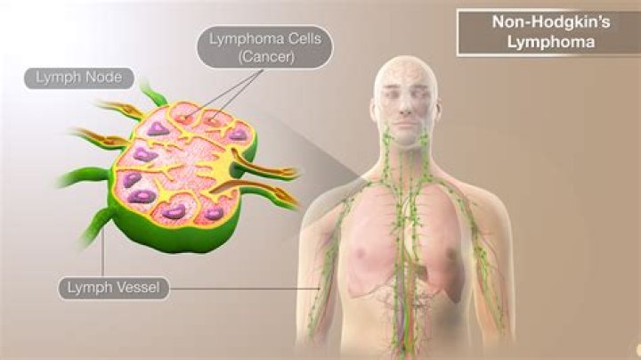 Is non Hodgkin's lymphoma terminal?