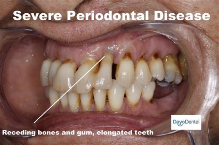 Is periodontitis irreversible?