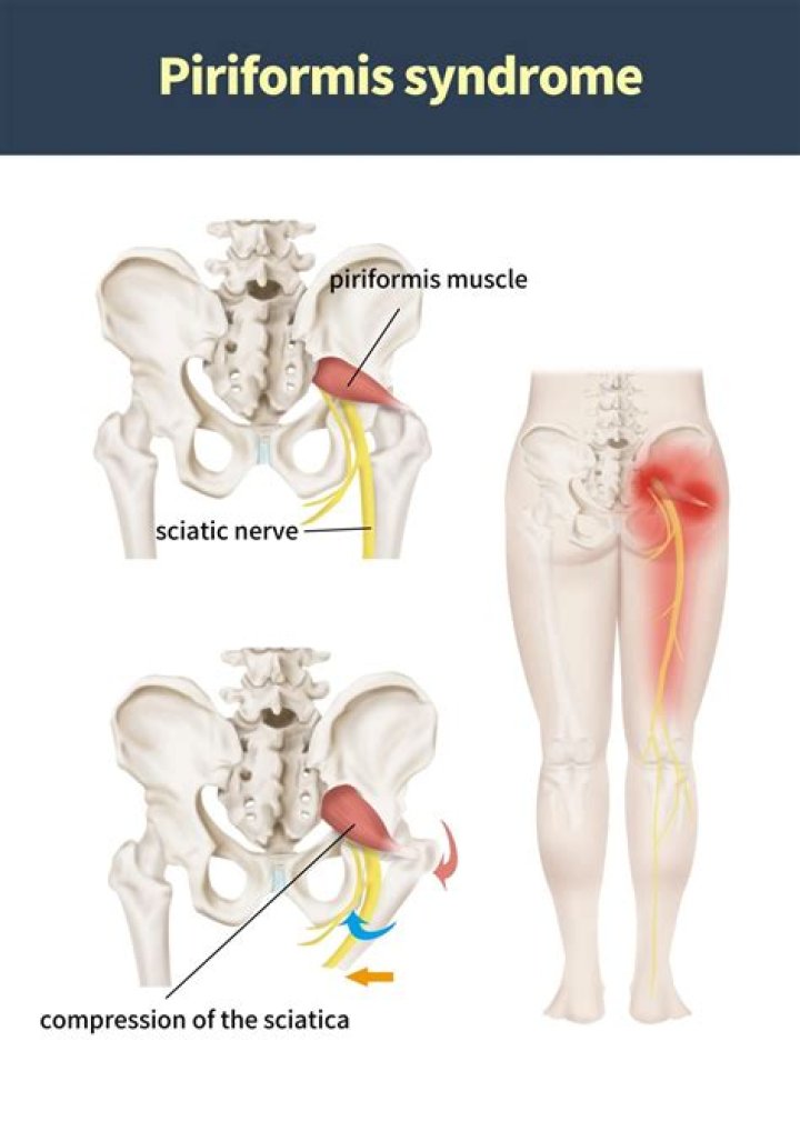 Is piriformis syndrome sciatica?