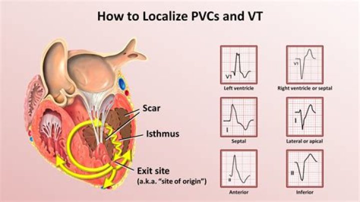 Is PVC cancerous?