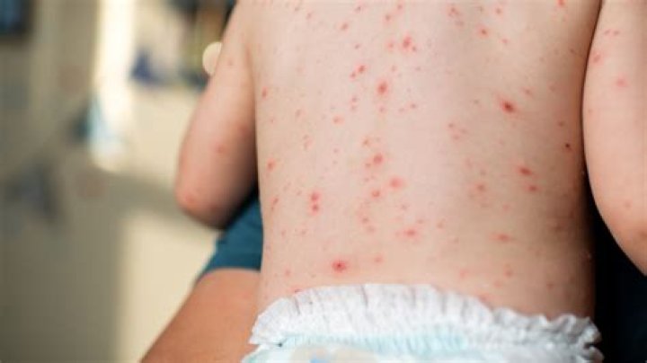 Is smallpox worse than chicken pox?