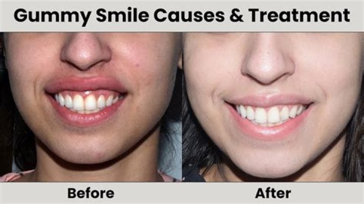 Is smile surgery allowed in Army?