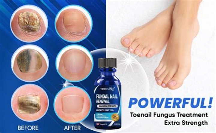 Is there a prescription drug to cure toenail fungus?