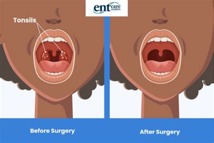 Is there an alternative to tonsillectomy?
