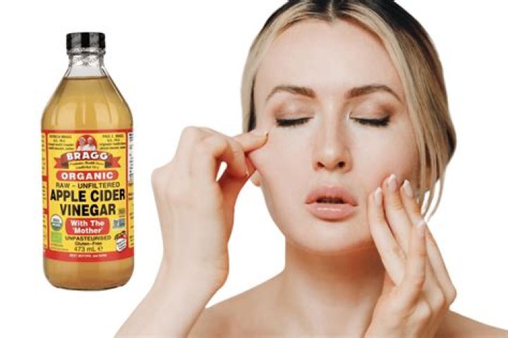 Should I wash off apple cider vinegar on my face?
