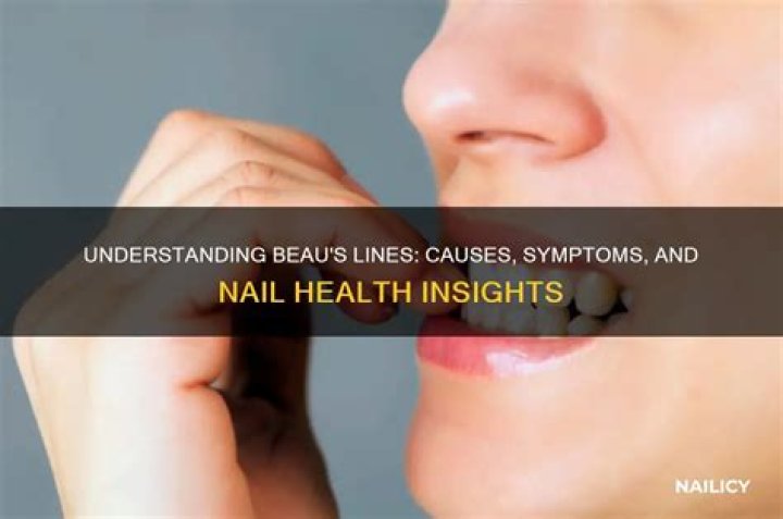 What are Beau's lines?