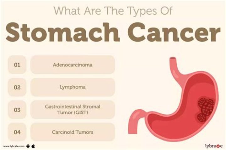 What are symptoms of stomach tumors?