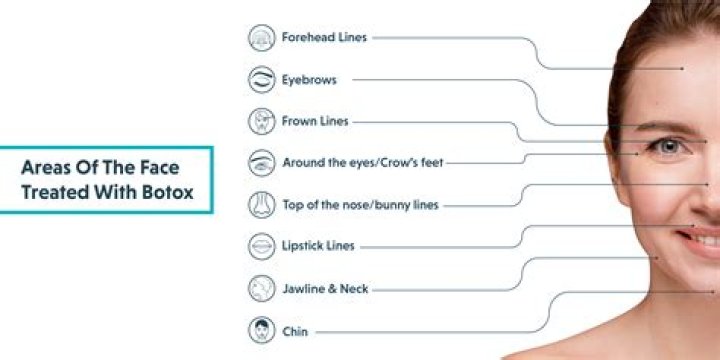 What are the 4 areas of Botox?