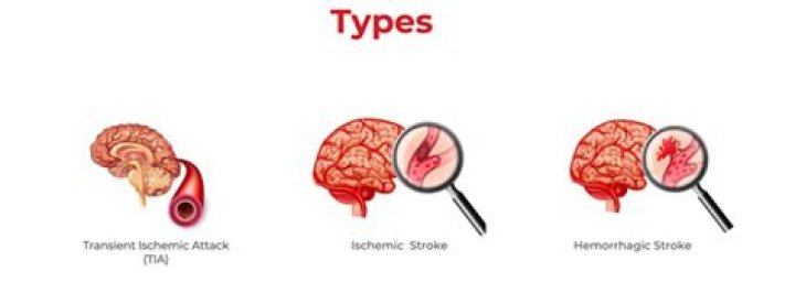 What are the 4 causes of a stroke?