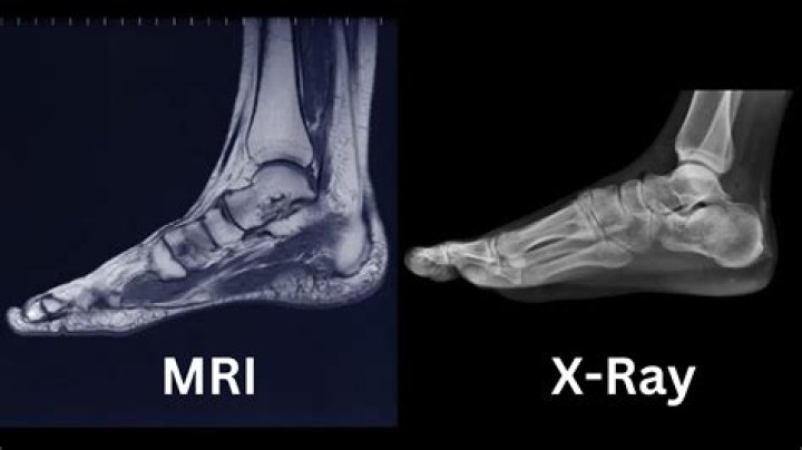 What can an MRI show for foot pain?