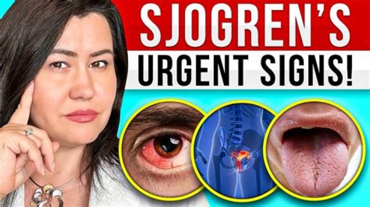 What causes a Sjogren's flare up?