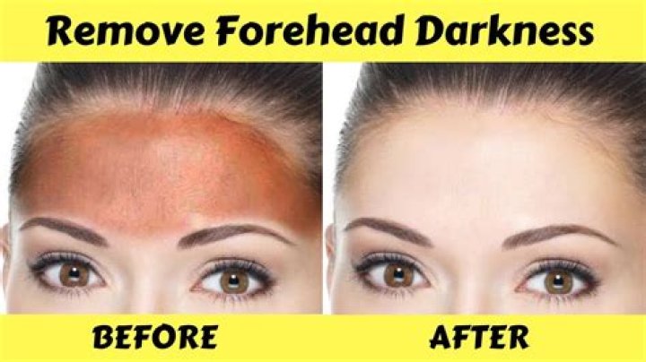 What causes dark forehead?