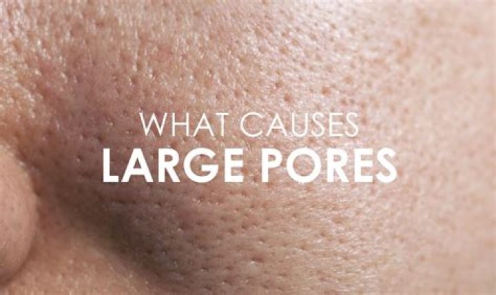 What causes large pores?