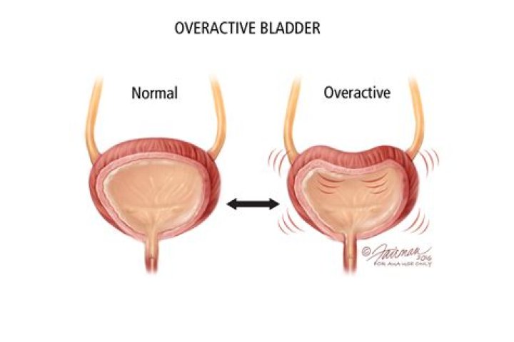 What causes overactive bladder?
